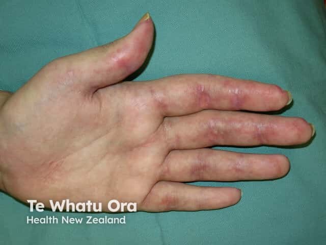 Dermatomyositis of the hand