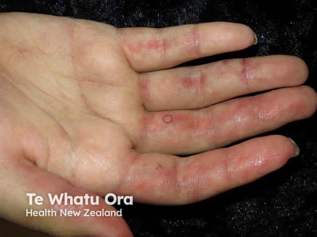 Dermatomyositis of the hand