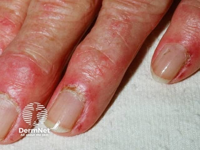 Dermatomyositis of the hand