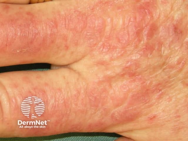 Dermatomyositis of the hand