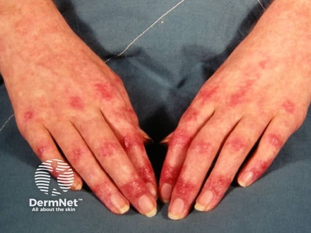 Dermatomyositis of the hand