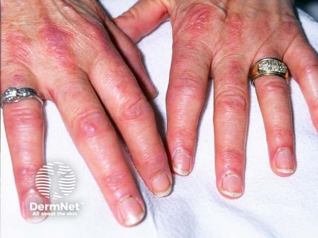 Dermatomyositis