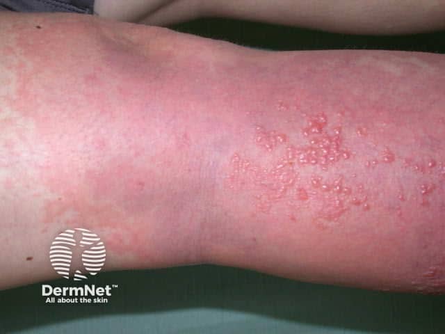 Dermatomyositis of the leg