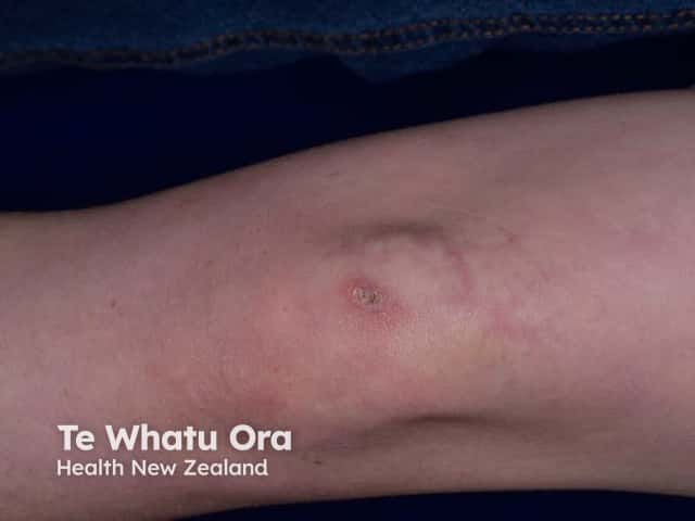 Dermatomyositis of the leg