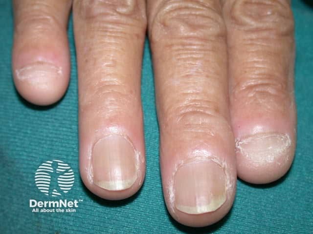 Dermatomyositis of the nailfold