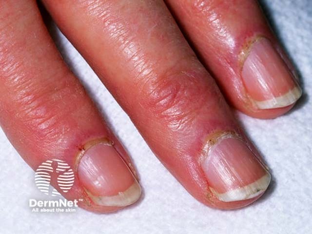 Dermatomyositis of the nail fold