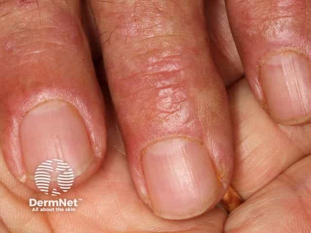 Dermatomyositis of the nailfold