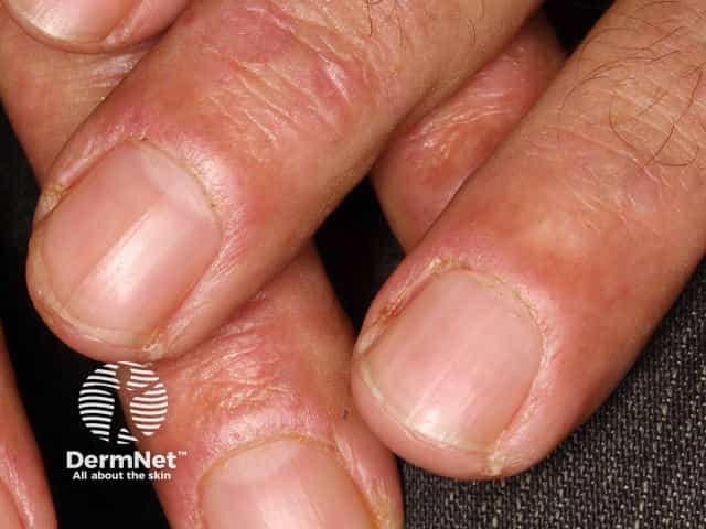 Dermatomyositis of the nailfold