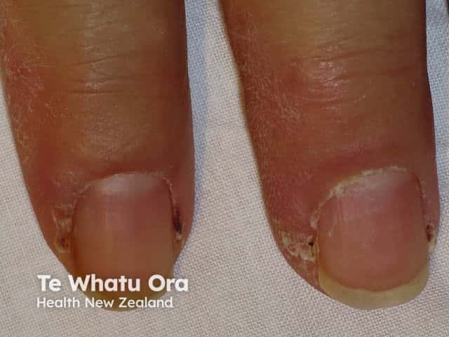 Dermatomyositis of the nailfold