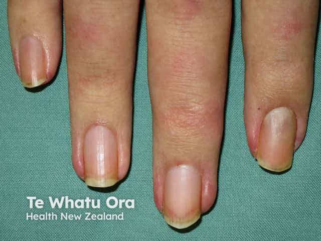 Dermatomyositis of the nailfold