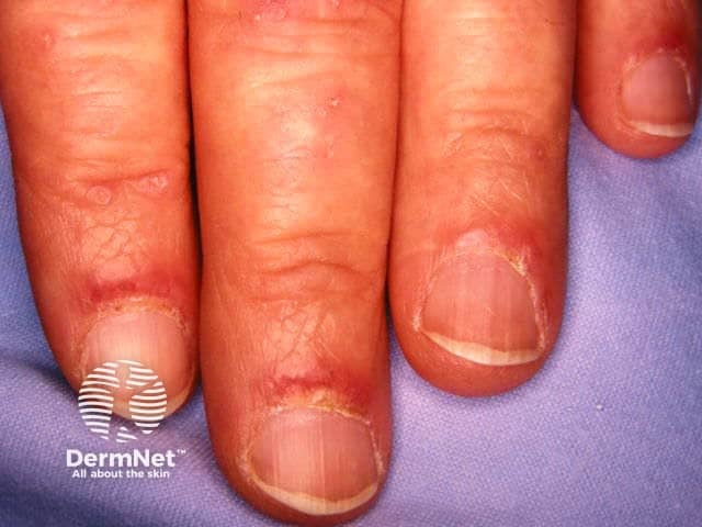 Ragged cuticles and nailfold redness