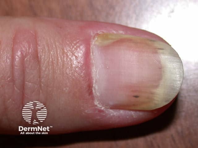 Dermatomyositis of the nailfold