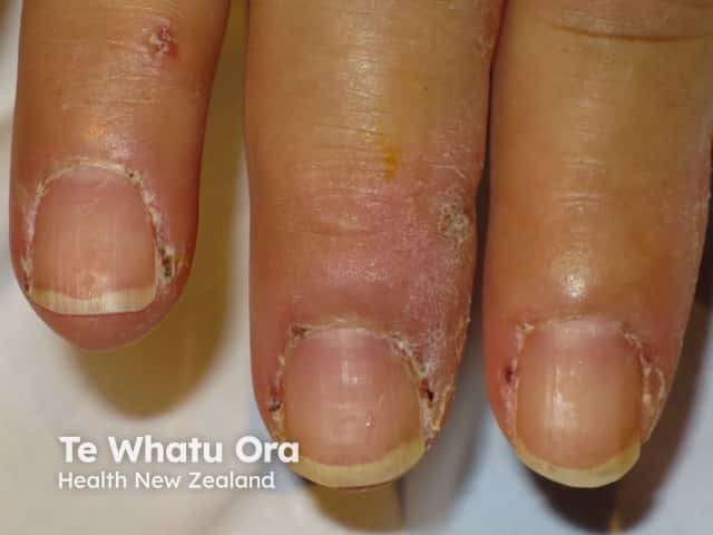 Nailfold changes in dermatomyositis