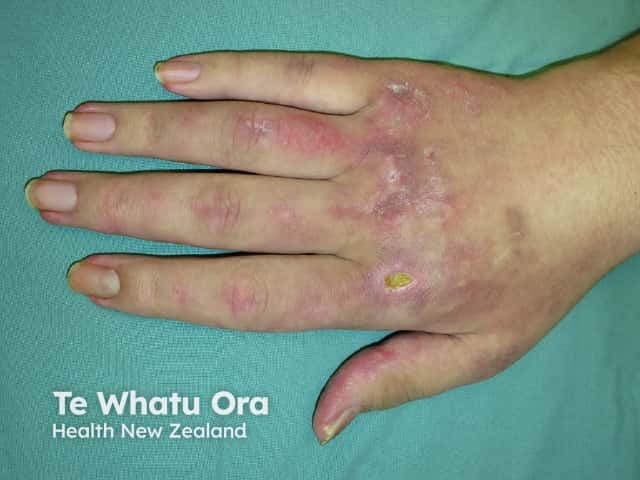 Dermatomyositis