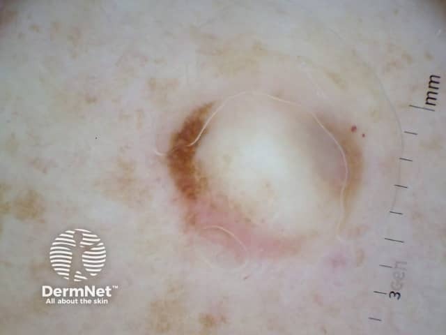 Desmoplastic melanoma 1, dermoscopy