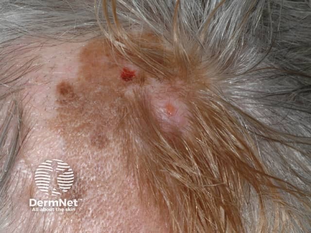 Desmoplastic melanoma