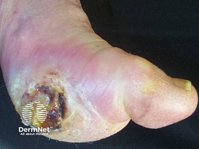 Ulcer due to diabetic neuropathy