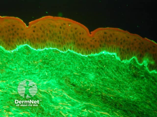 Linear deposit of IgA at the dermoepidermal junction on direct immunofluorescence