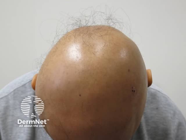 Alopecia universalis