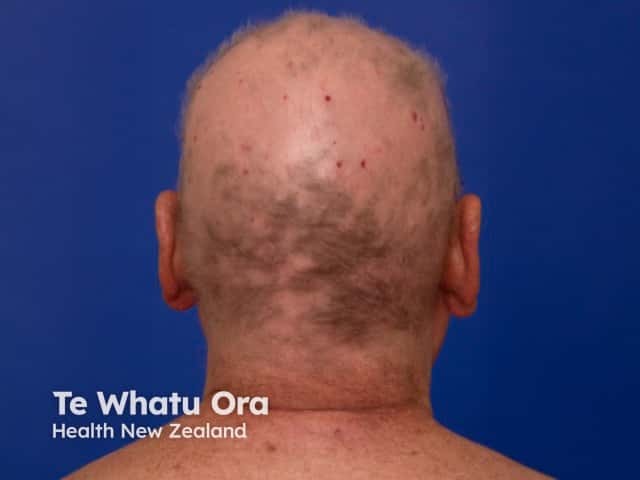 Alopecia areata