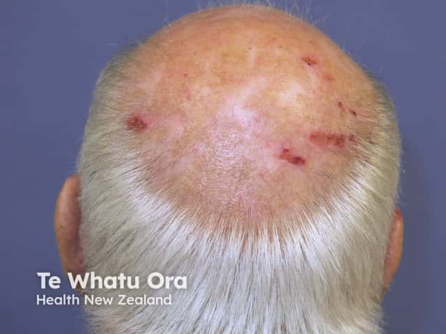 Male pattern alopecia