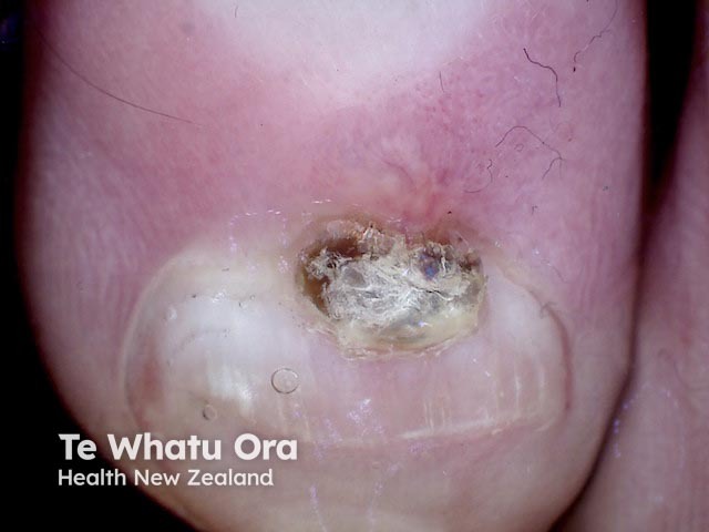 Digital myxoid cyst, toenail