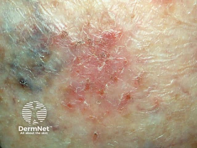 Nummular dermatitis