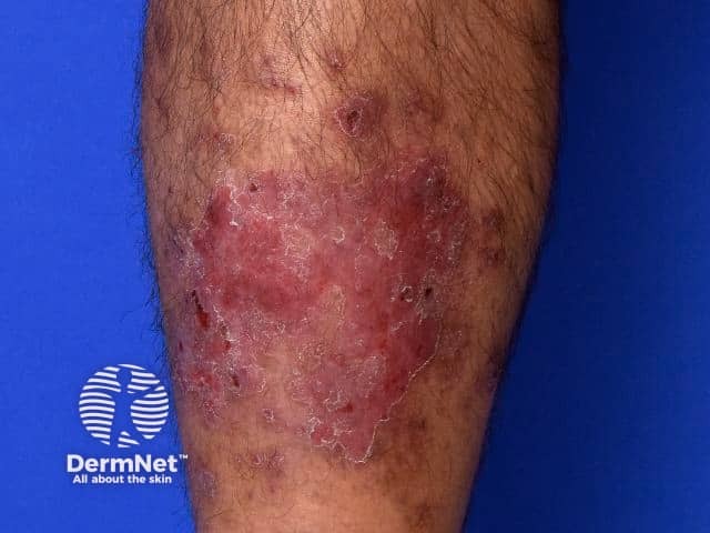 Nummular dermatitis