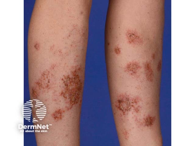 Discoid eczema