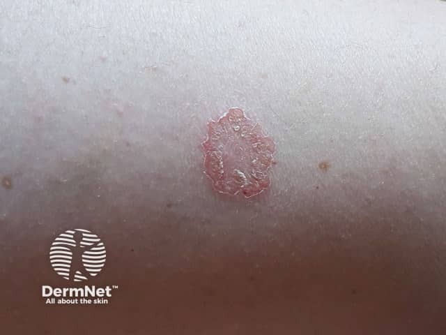 Discoid eczema day 14