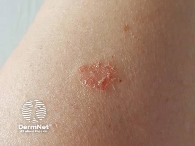 Discoid eczema day 6