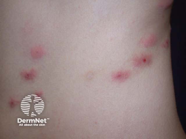 Bedbug bites