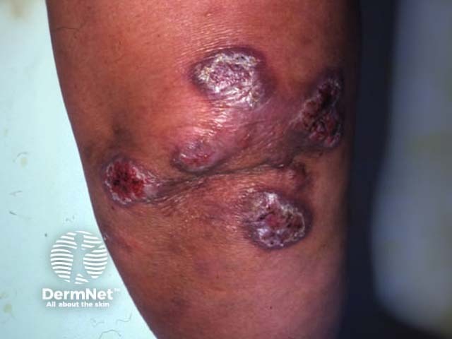 Mycobacterium marinum infection