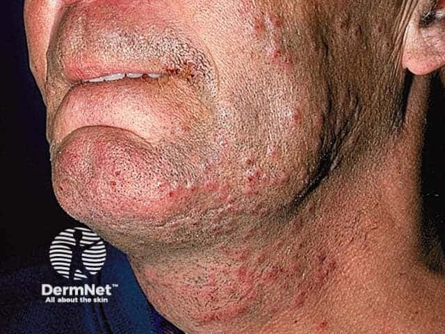 Pseudofolliculitis