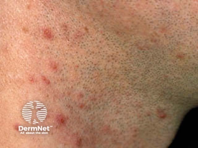 Pseudofolliculitis