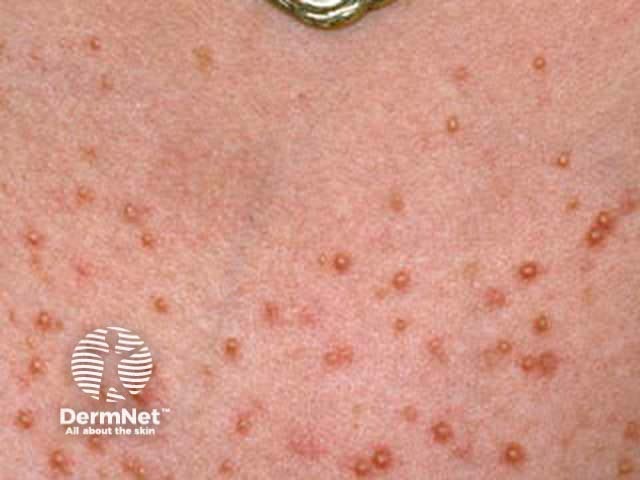 Pityrosporum folliculitis