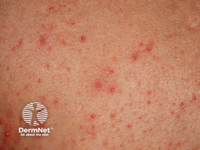 Pityrosporum folliculitis