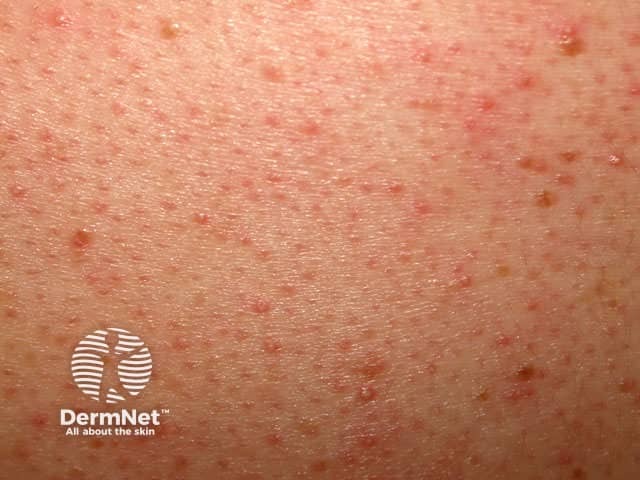 Pityrosporum folliculitis