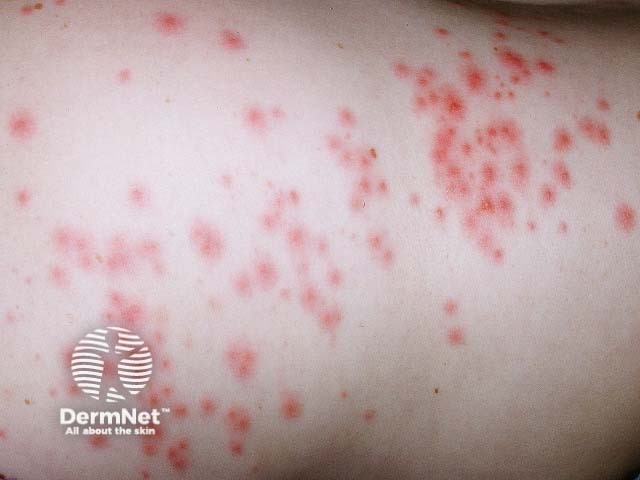 Pseudomonas folliculitis