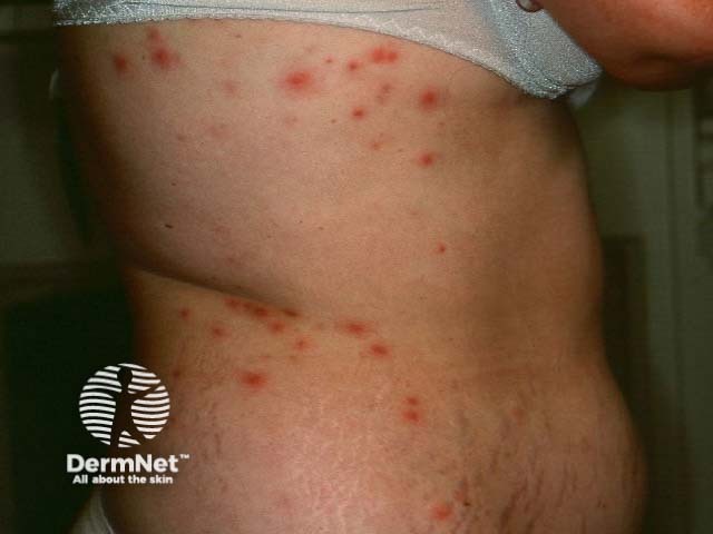 Pseudomonas folliculitis