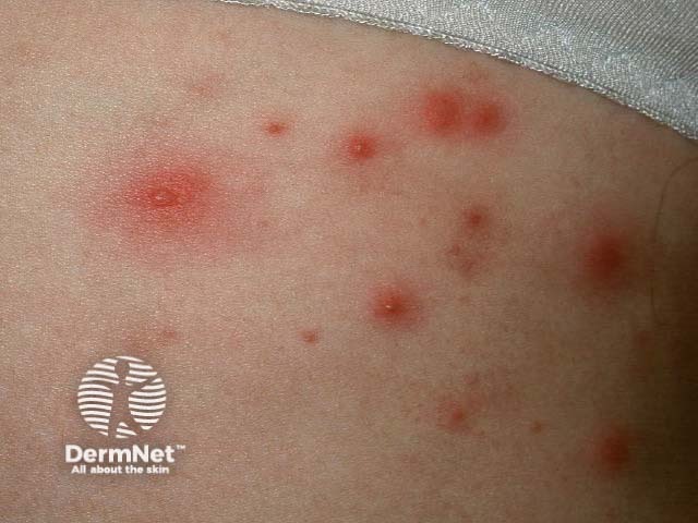 Pseudomonas folliculitis