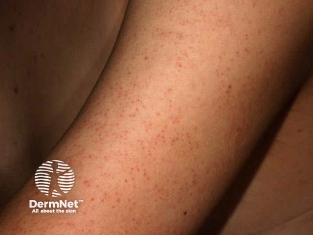 Keratosis pilaris