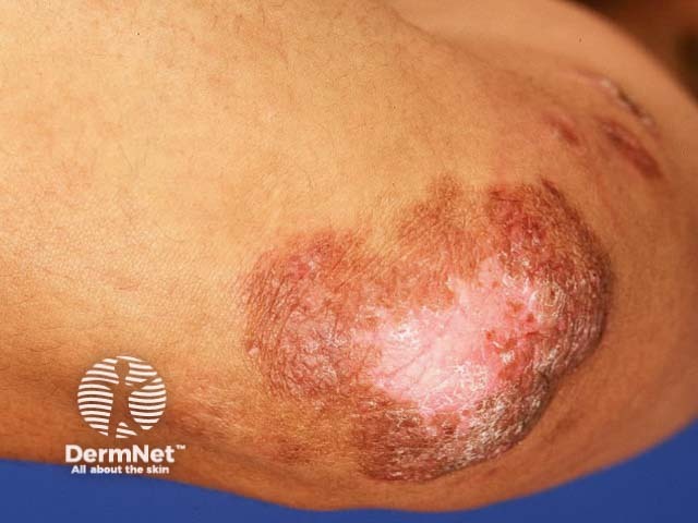 Cutaneous TB