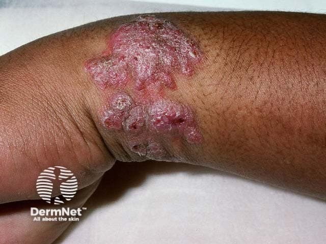 Cutaneous TB