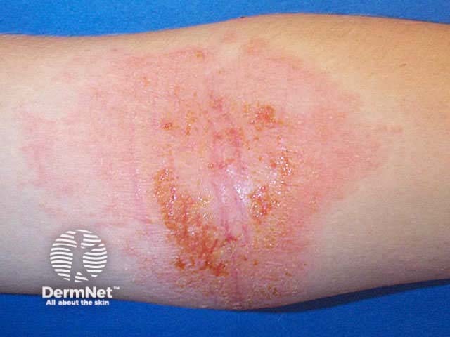 Acute dermatitis