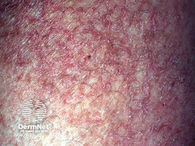 Asteatotic eczema