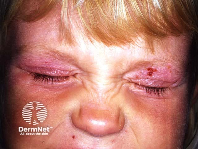 Atopic dermatitis