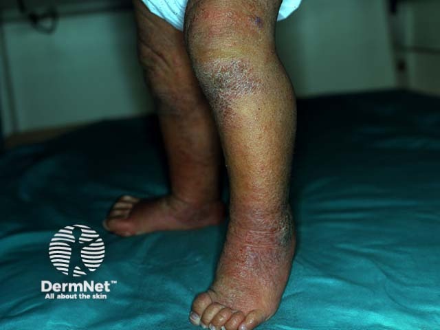 Atopic dermatitis