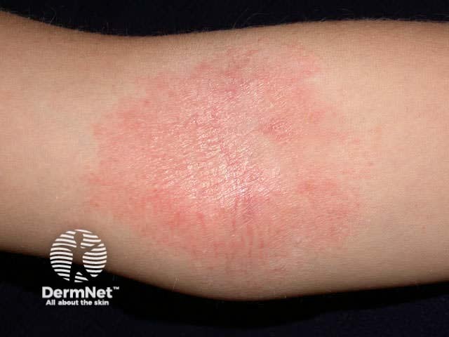 Atopic dermatitis