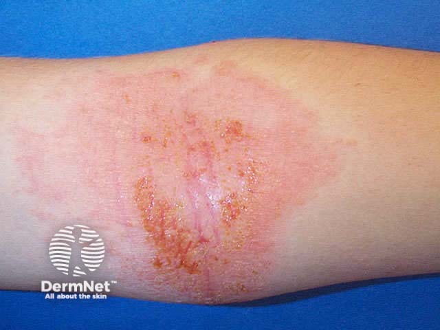 Atopic dermatitis